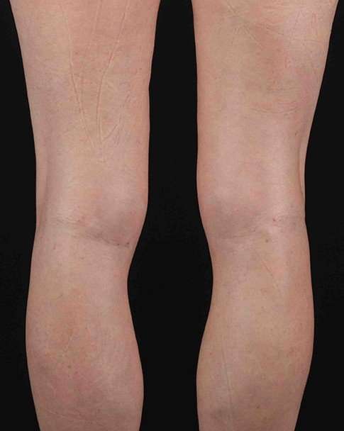 Quantum Rf Before & After Patient #925
