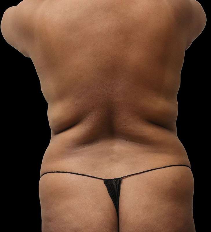 Tummy Tuck Before & After Patient #2389