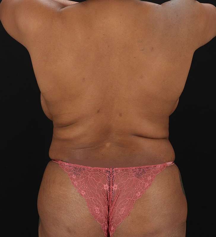 Tummy Tuck Before & After Patient #2402
