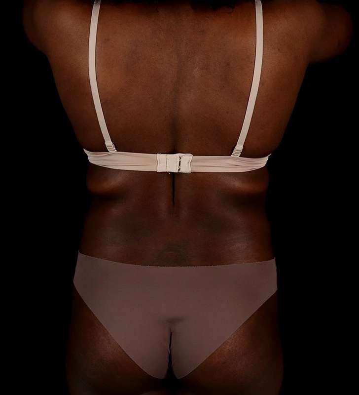 Tummy Tuck Before & After Patient #2448