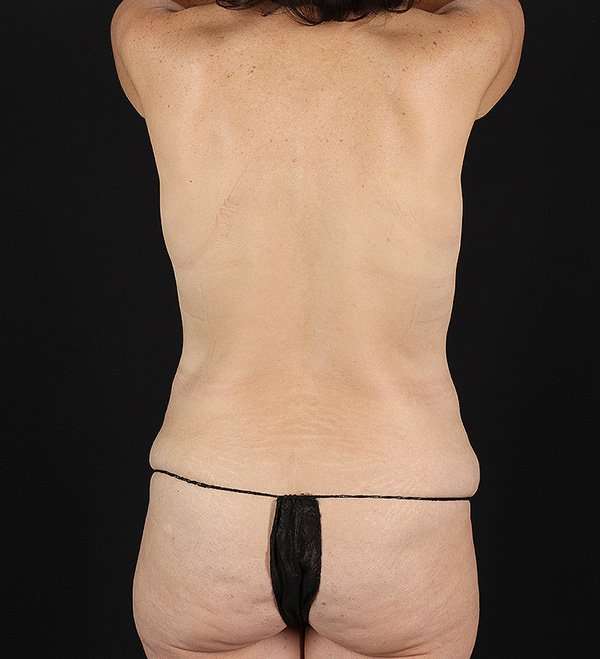 Tummy Tuck Before & After Patient #2474