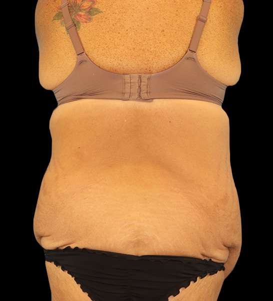 Circumferential Body Lift Before & After Patient #2509