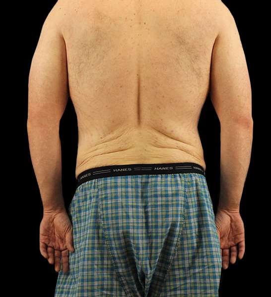 Circumferential Body Lift Before & After Patient #2522