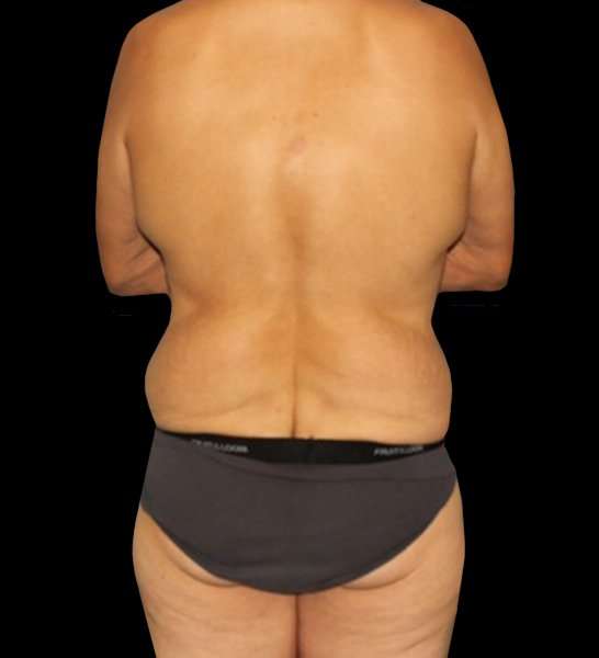 Circumferential Body Lift Before & After Patient #2535