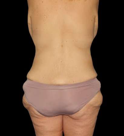 Circumferential Body Lift Before & After Patient #2559