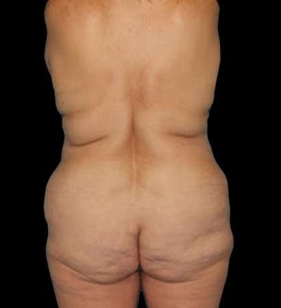 Circumferential Body Lift Before & After Patient #2572