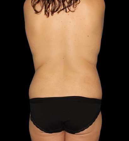 Circumferential Body Lift Before & After Patient #2585