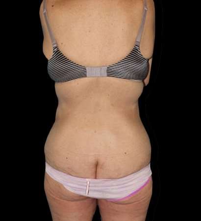 Circumferential Body Lift Before & After Patient #2598