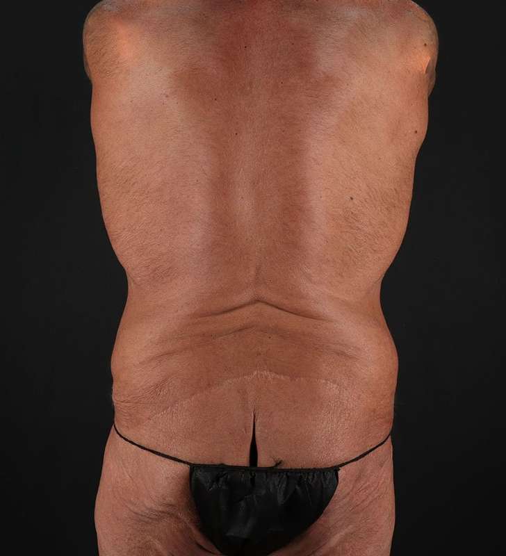 Circumferential Body Lift Before & After Patient #2611