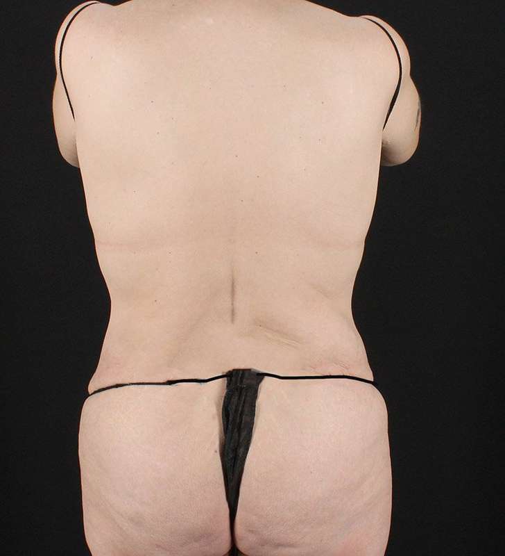 Circumferential Body Lift Before & After Patient #2624