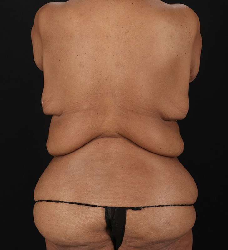 Circumferential Body Lift Before & After Patient #2637