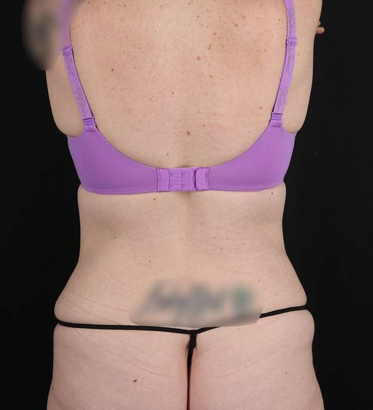 Circumferential Body Lift Before & After Patient #2650