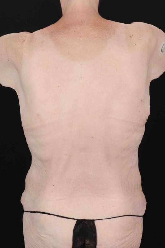 Circumferential Body Lift Before & After Patient #2663