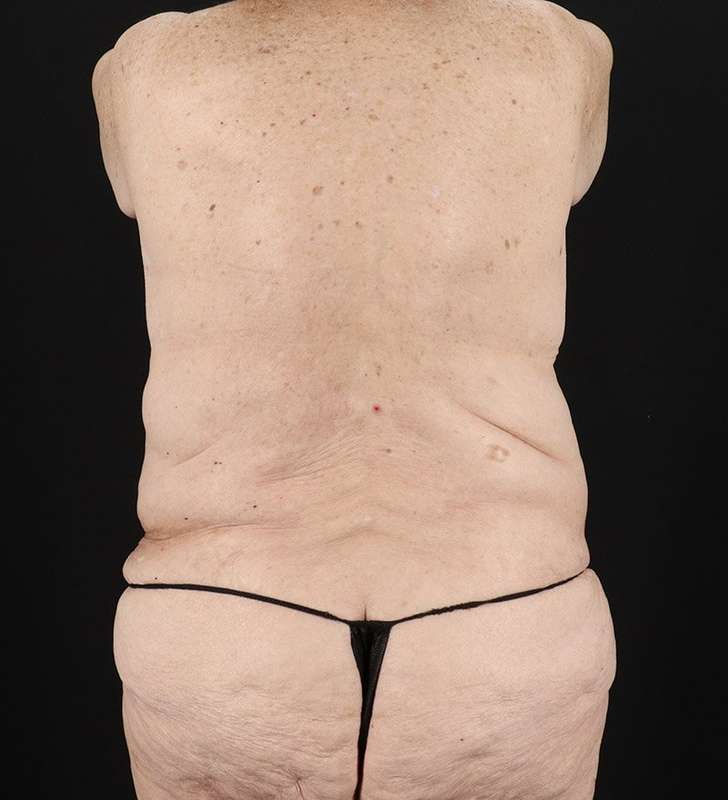 Fleur De Lis Tummy Tuck Before & After Patient #2727