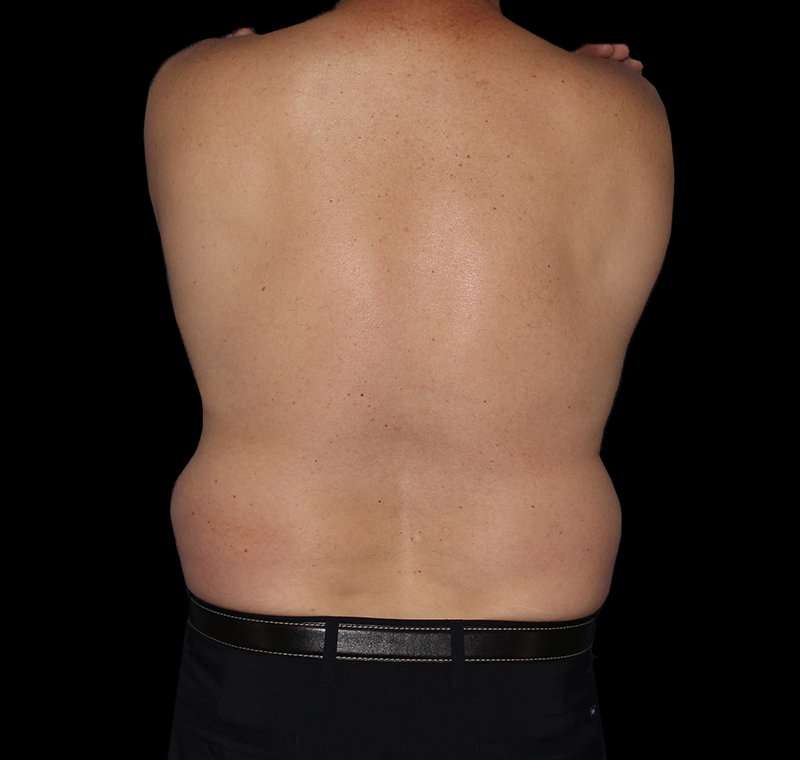 Liposuction Before & After Patient #2756