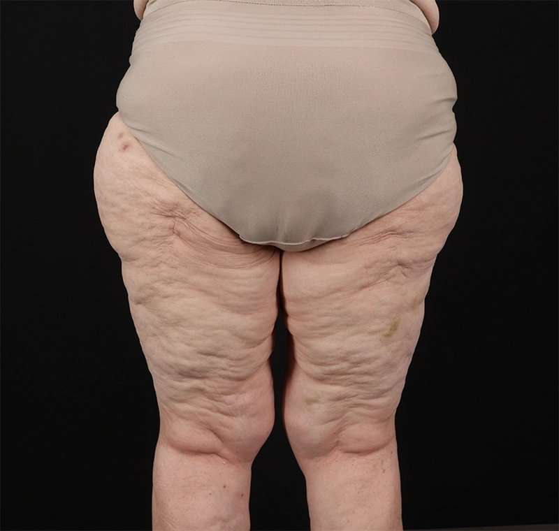 Liposuction Before & After Patient #2829