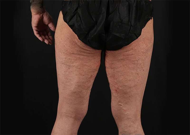 Thigh Lift Before & After Patient #2992