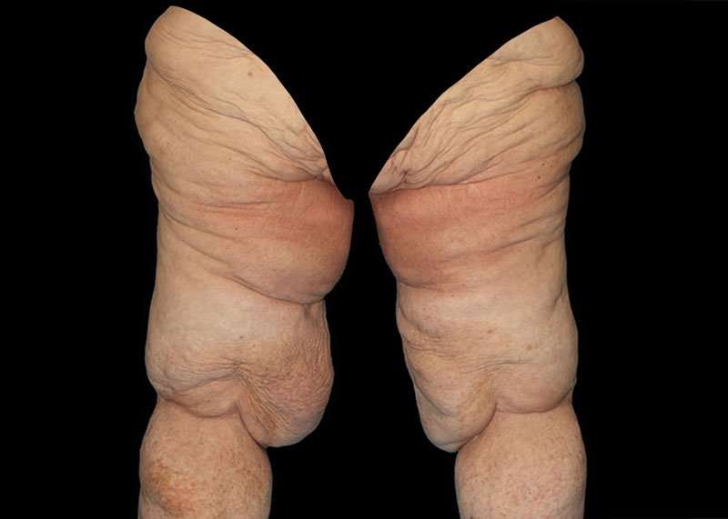 Thigh Lift Before & After Patient #3005