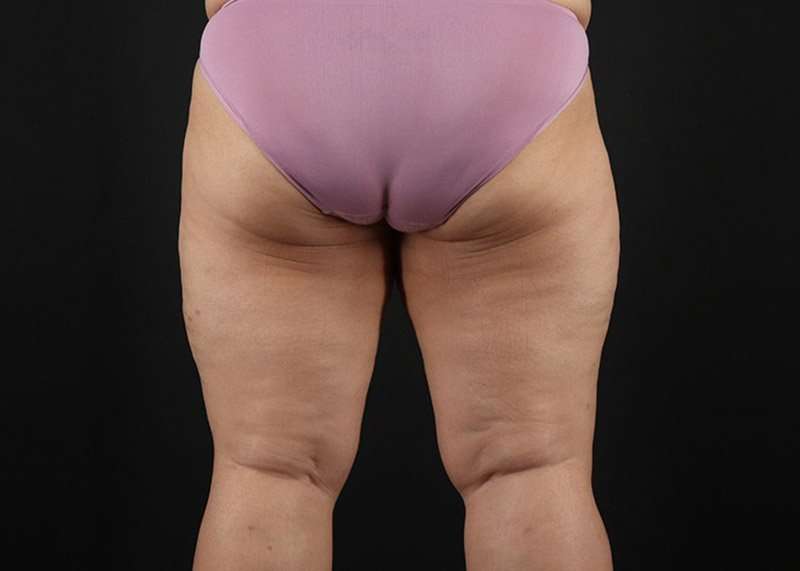 Thigh Lift Before & After Patient #3018