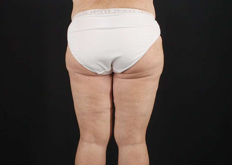 Thigh Lift Before & After Patient #3031