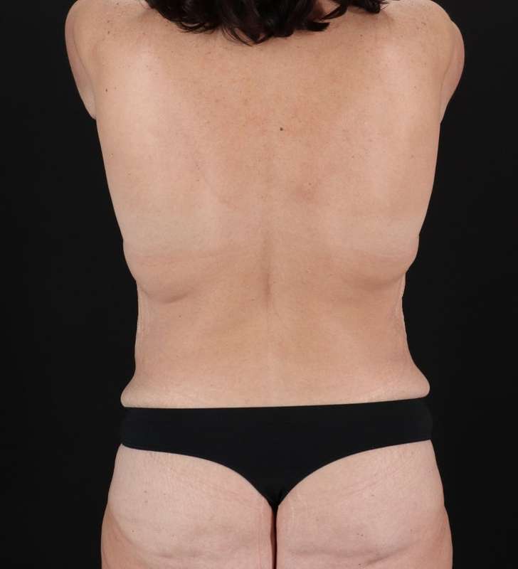 Augmentation/Lift Before & After Patient #1162