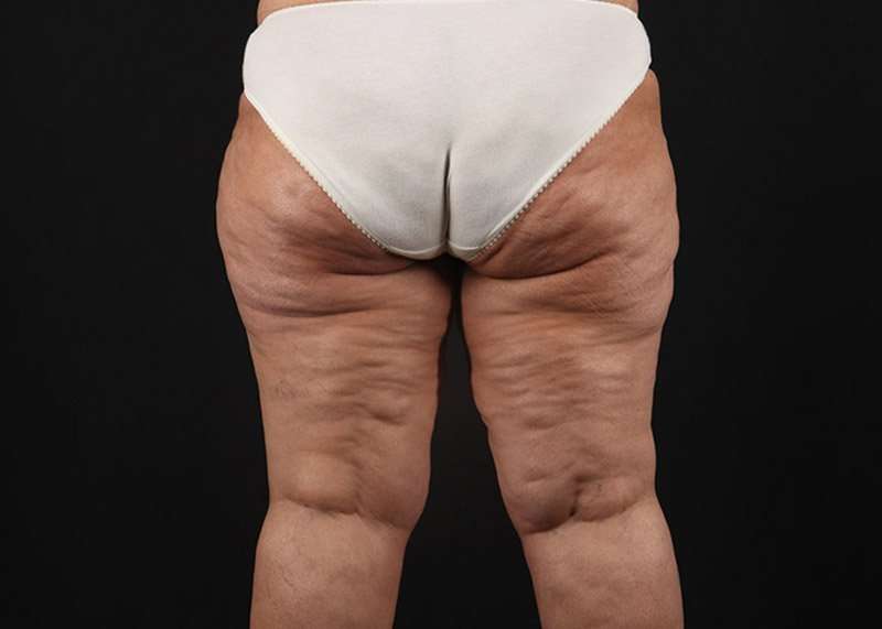 Thigh Lift Before & After Patient #3044