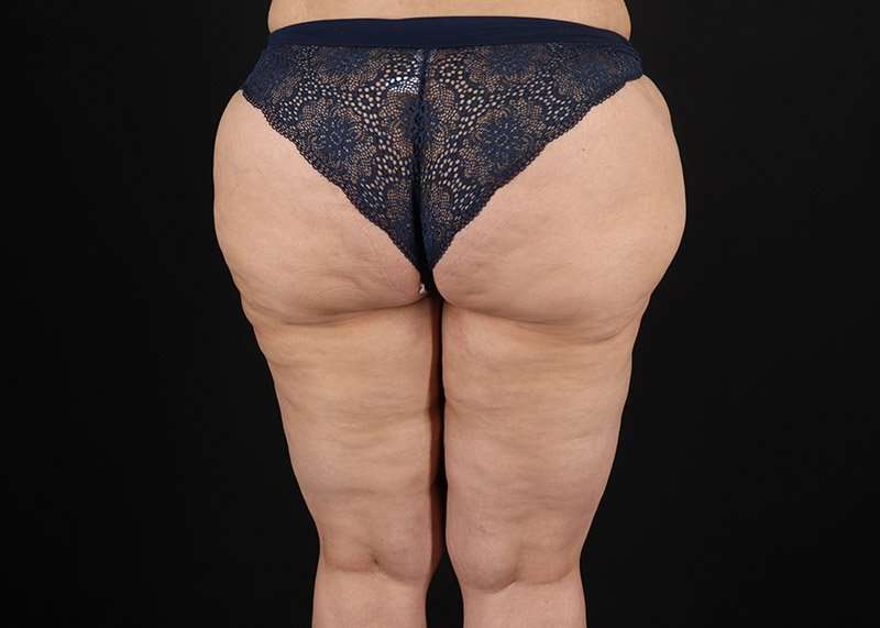 Thigh Lift Before & After Patient #3057