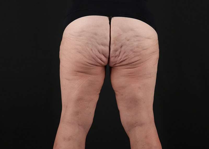 Thigh Lift Before & After Patient #3070