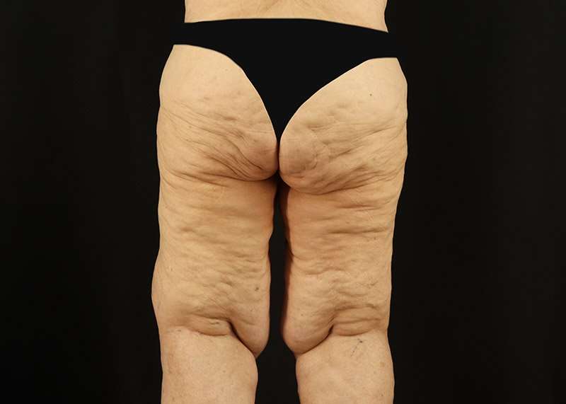 Thigh Lift Before & After Patient #3083