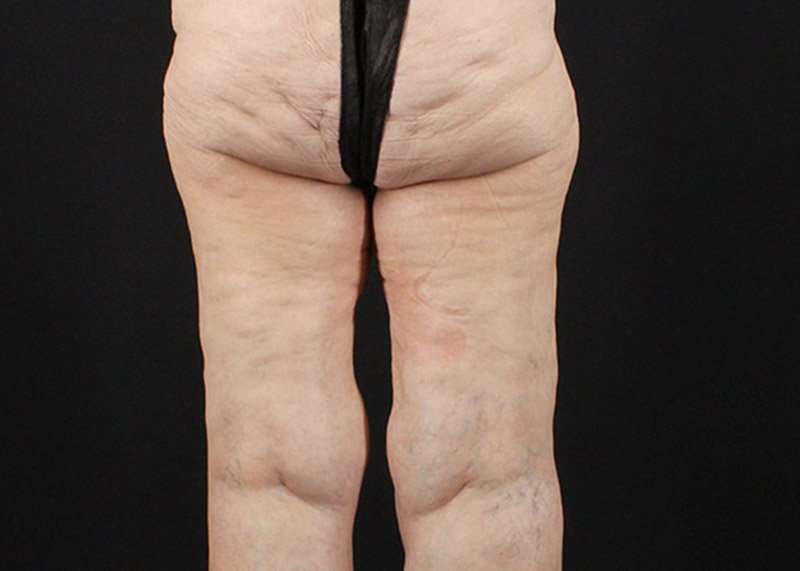 Thigh Lift Before & After Patient #3096