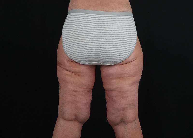Thigh Lift Before & After Patient #3109