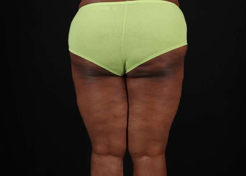 Thigh Lift Before & After Patient #3122