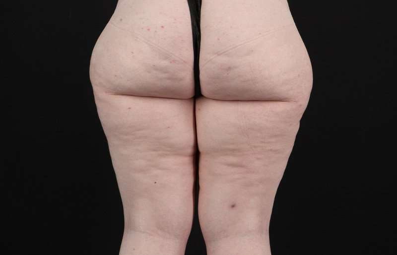Thigh Lift Before & After Patient #3135