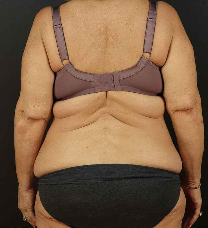 Tummy Tuck Revision Before & After Patient #3181