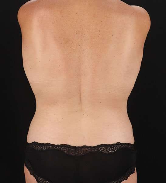 Tummy Tuck Before & After Patient #2247