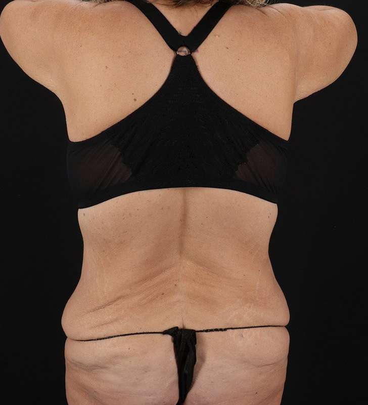 Tummy Tuck Before & After Patient #2326