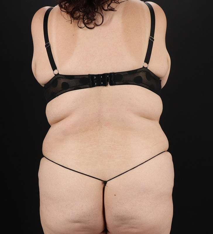 Tummy Tuck Before & After Patient #2339