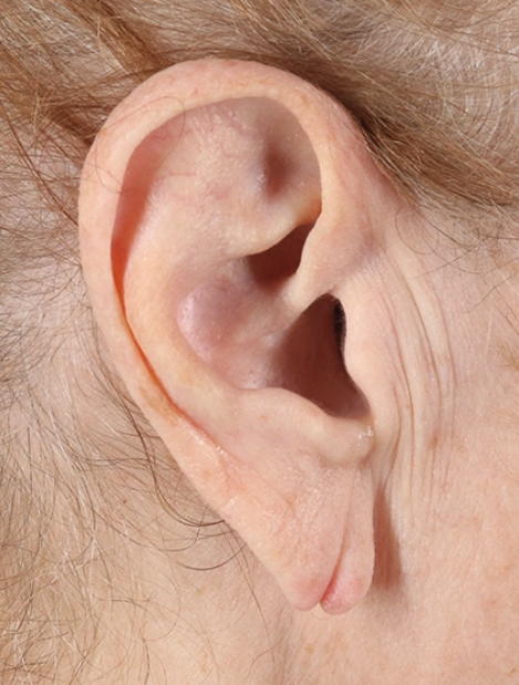 Earlobe Repair Before & After Patient #3482