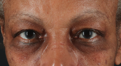 Blepharoplasty (Eyelid Surgery) Before & After Patient #3491