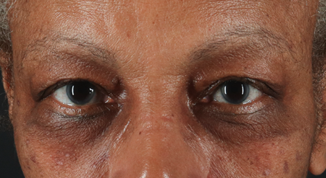 Blepharoplasty (Eyelid Surgery) Before & After Patient #3491