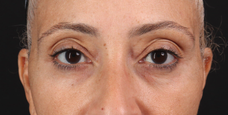 Blepharoplasty (Eyelid Surgery) Before & After Patient #3492