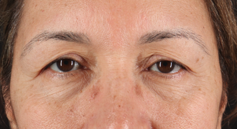Blepharoplasty (Eyelid Surgery) Before & After Patient #3493