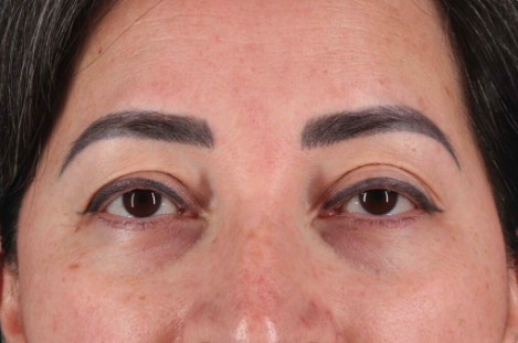 Blepharoplasty (Eyelid Surgery) Before & After Patient #3494