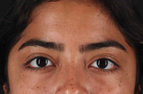 Blepharoplasty (Eyelid Surgery) Before & After Patient #3495