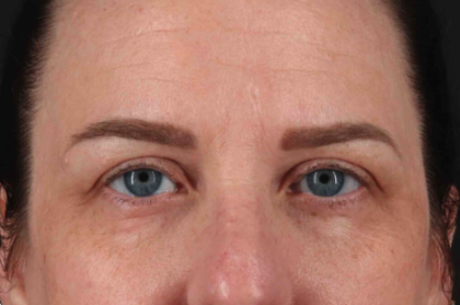 Blepharoplasty (Eyelid Surgery) Before & After Patient #3496
