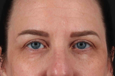 Blepharoplasty (Eyelid Surgery) Before & After Patient #3496