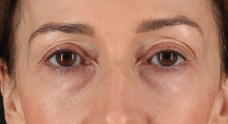 Blepharoplasty (Eyelid Surgery) Before & After Patient #3483