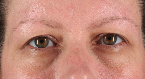 Blepharoplasty (Eyelid Surgery) Before & After Patient #3484