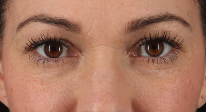 Blepharoplasty (Eyelid Surgery) Before & After Patient #3485