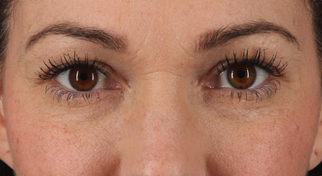 Blepharoplasty (Eyelid Surgery) Before & After Patient #3485